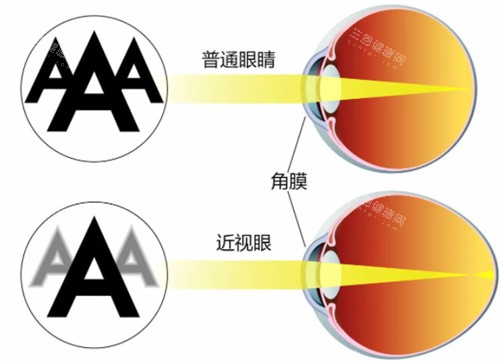 近视眼镜与正常眼睛视物区别
