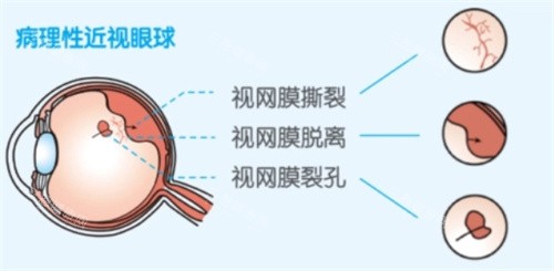 视网膜问题