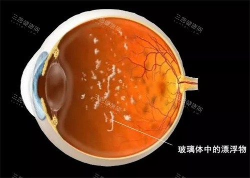 玻璃体混浊