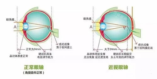 近视眼和正常眼睛区别