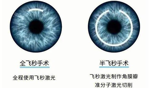 全飞秒和半飞秒手术对比