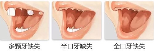 不同牙齿缺失程度