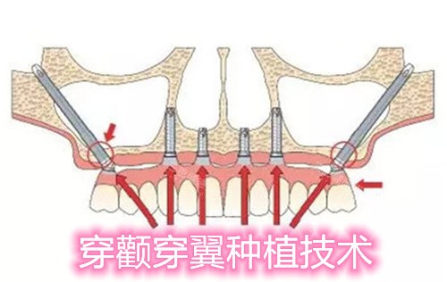 穿颧穿翼种植牙模型图