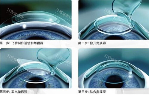 激光手术过程细节图