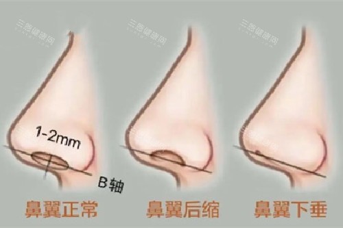 鼻翼美学