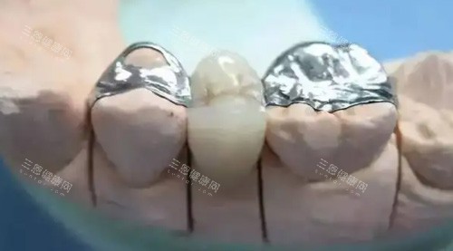 镶牙治疗细节图