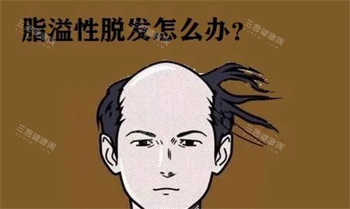 脂溢性脱发怎么办