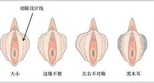 女性私密阴唇整形示意图