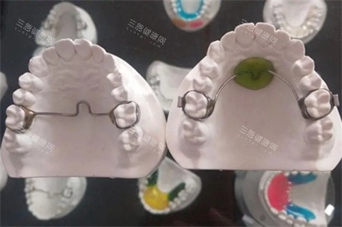 nance弓和横腭杆模型对比图