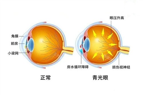 青光眼与正常眼对比图