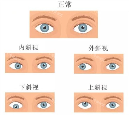 不同情况的斜视眼睛