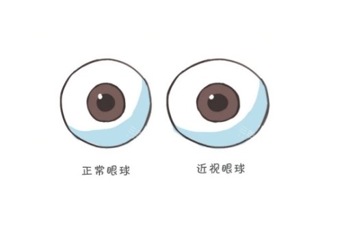 正常眼球与近视眼球卡通对比图