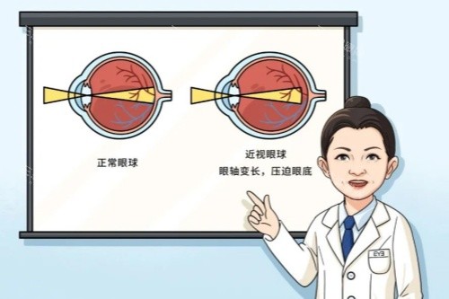 正常眼睛和近视眼睛对比图