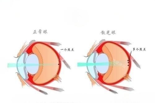 正常眼睛与散光眼睛概念对比图