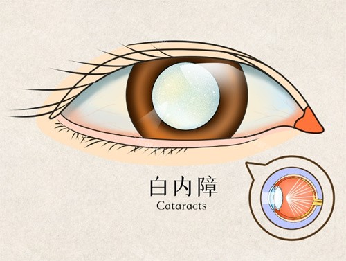 【在线速查】贵阳白内障免费治疗的医院问询：免费治疗条件|申请流程|口碑医院等