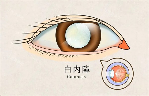 六安白内障手术有免费的吗，六安白内障手术免费政策/申请条件/申请流程查看！