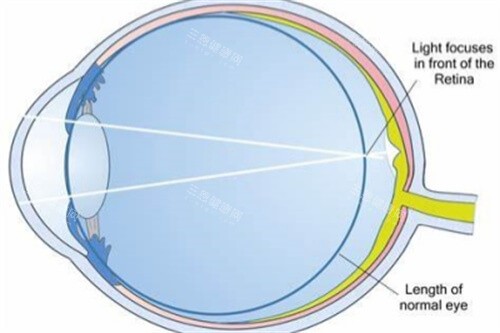 屈光不正近视示意图