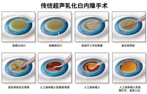 白内障超声乳化手术流程图