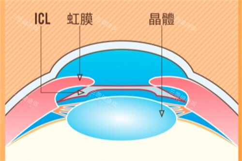 ICL示意图