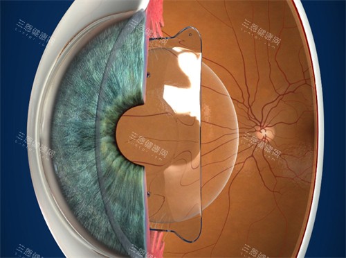 进行晶体植入的眼睛