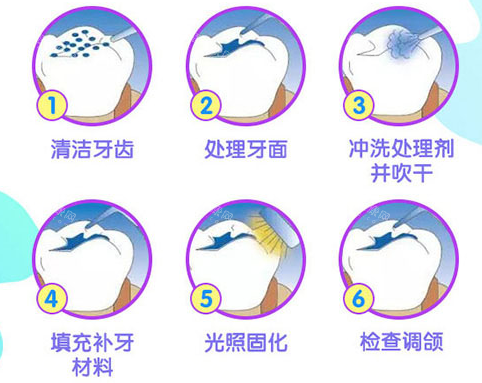 盐城中喜口腔补牙过程展示