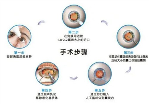 河北省白内障手术晶体报销比例是多少，大型综合医院报销比例在30%-40%之间！