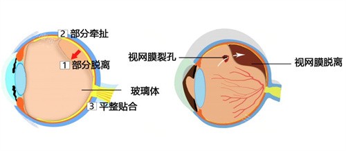 视网膜脱离