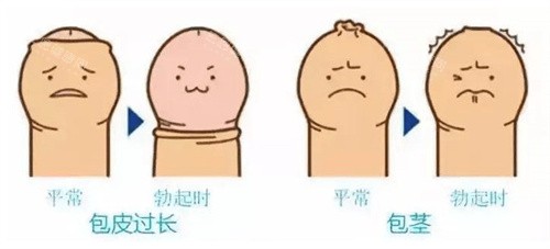 包皮过长和包茎