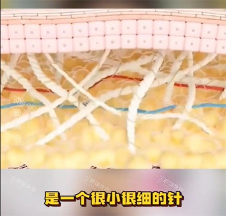 私密紧致针好不好 私密紧致针好不好