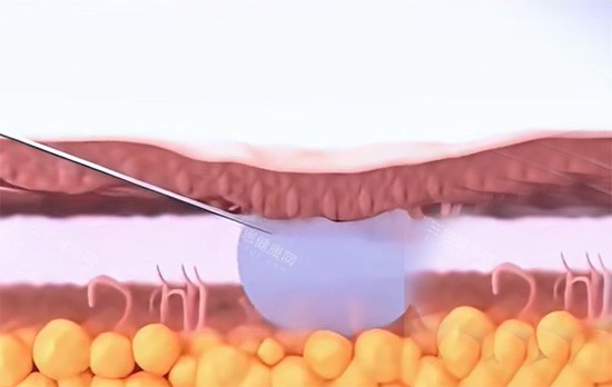 紧缩针填充私密位置照片 紧缩针填充私密位置照片