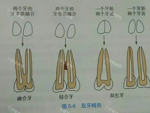 融合牙结合牙双生牙示意图