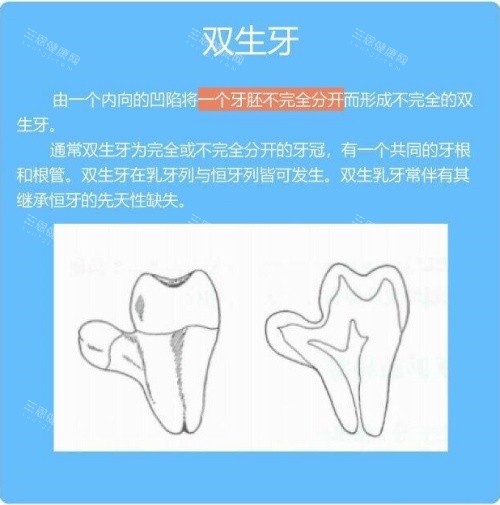 双生牙介绍示意图