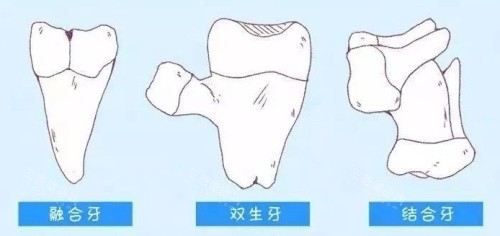 融合牙结合牙双生牙漫画图
