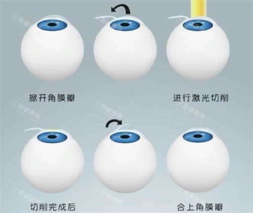 半飞秒手术过程 半飞秒手术过程