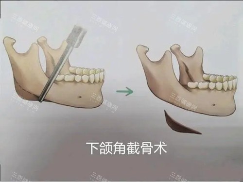 下颌角截骨术卡通示意图