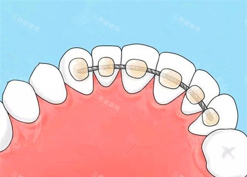 深圳福永牙齿矫正多少钱？金属矫正6.8k+隐形矫正2w+舌侧矫正5w+