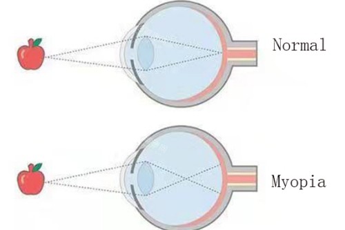 近视眼与正常眼对比