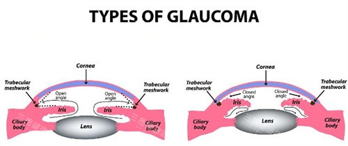 开角型和闭角型青光眼