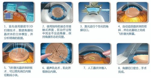 超声乳化白内障手术细节