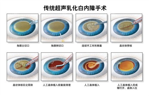 2025年衢州白内障免费手术政策解读！含详细政策内容+申请条件+申请流程供你查看