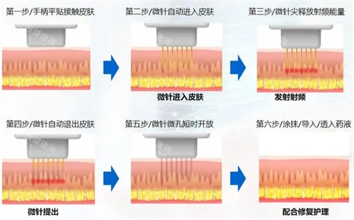 微针操作流程图解 微针操作流程图解