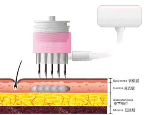 微针可以达到的肌肤层次图解 微针可以达到的肌肤层次图解