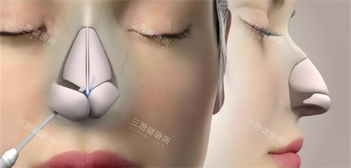 鼻综合鼻骨动画 鼻综合鼻骨动画