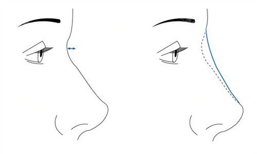 隆鼻手术前后对比 隆鼻手术前后对比