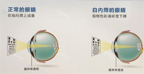 石家庄爱尔眼科白内障的眼睛示意图