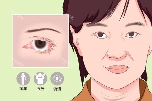 急性结膜炎症状图