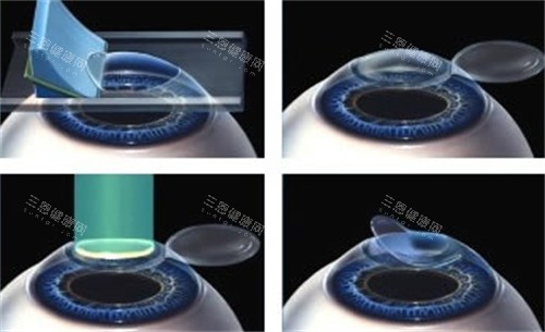 准分子激光手术过程