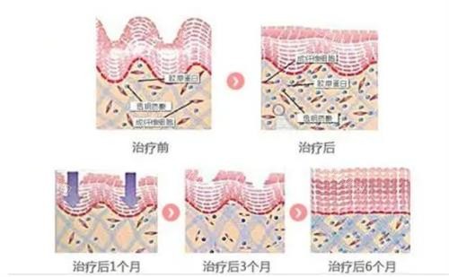 热拉提的治疗成效