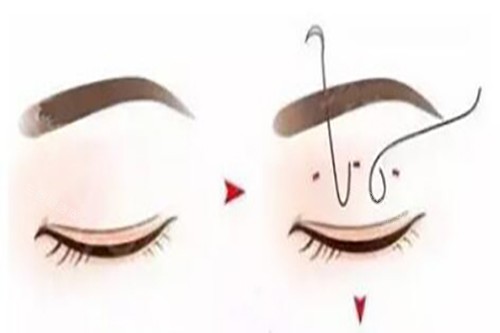 埋线双眼皮卡通示意图 埋线双眼皮卡通示意图