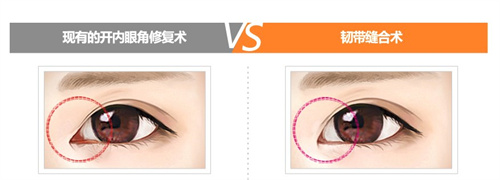内眼角修复两种手术对比
